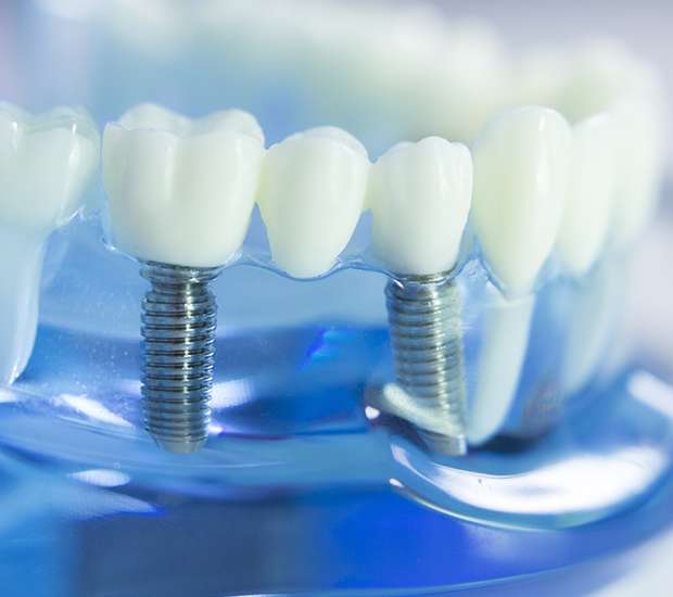 Dickson Dental Implants