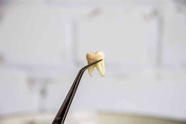 Aftercare Tips Following A Tooth Extraction